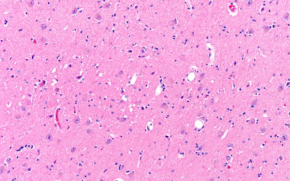 12E4 Fat Embolism (Case 12) N4 20X