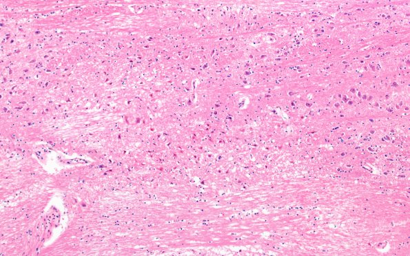 12F1 Fat Embolism (Case 12) N7 10X