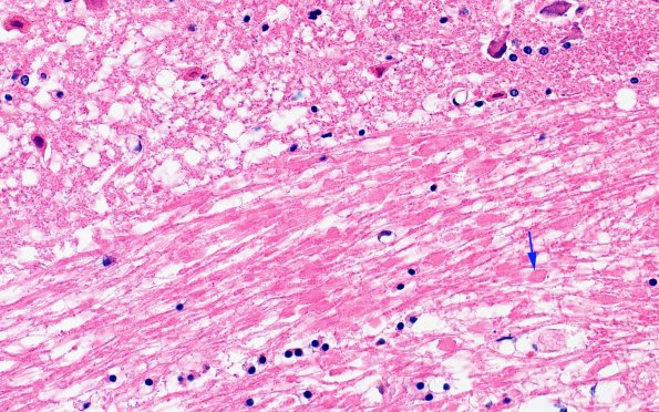 12F2 Fat Embolism (Case 12) N7 40X copy