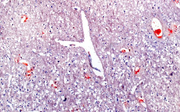 12G1 Fat emboli (Case 12) ORO 10X 2