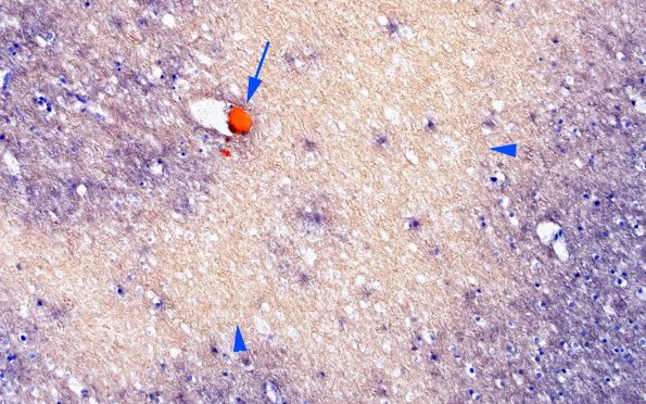 12G2 Fat emboli (Case 12) ORO 20X 3 copy