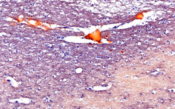 12G3 Fat emboli (Case 12) ORO 20X 4