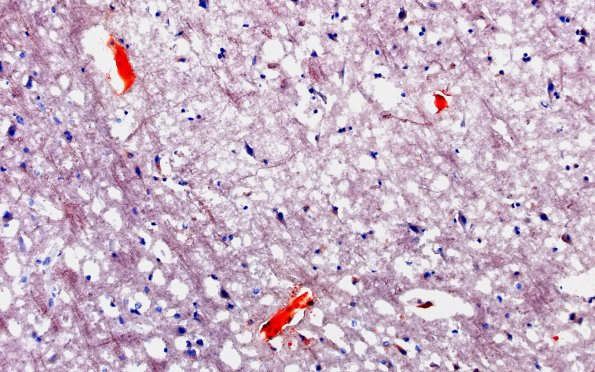 12G4 Fat emboli (Case 12) ORO 20X 1