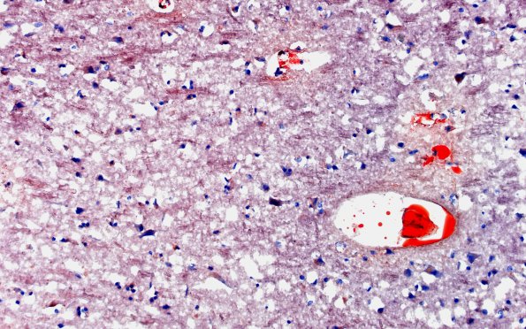 12G5 Fat emboli (Case 12) ORO 20X 2