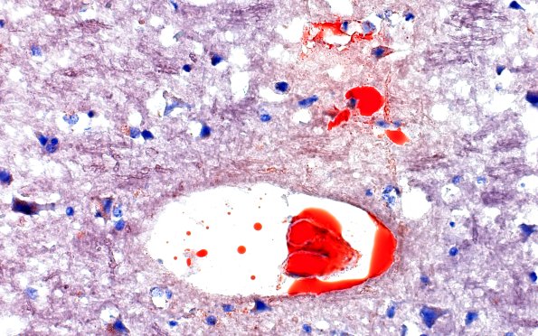 12G6 Fat emboli (Case 12) ORO 40X 4