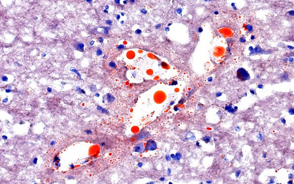 12G7 Fat emboli (Case 12) ORO 40X 2