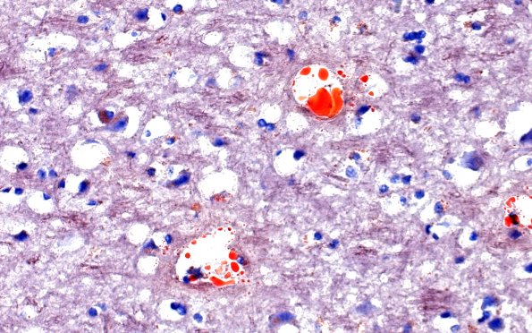 12G8 Fat emboli (Case 12) ORO 40X 1