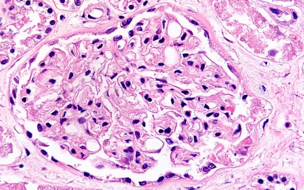 12H3Fat emboli (Case 12) H&E Renal 60X 1