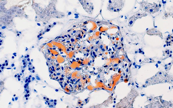 12I1 Fat emboli (Case 12) ORO Renal 40X 5