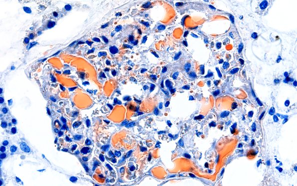 12I2 Fat emboli (Case 12) ORO Renal 60X 5