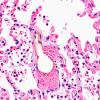 12K3 Fat Embolism (Case 12) Lung H&E 40X 2