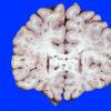 1A1 Fat Embolism (Case 1) 1