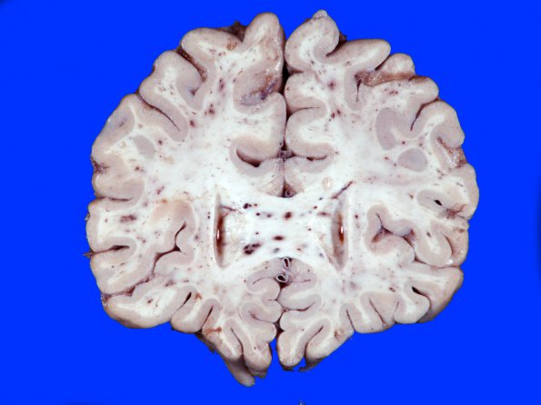 1A1 Fat Embolism (Case 1) 1