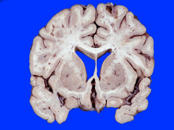 1A2 Fat Embolism (Case 1) 2