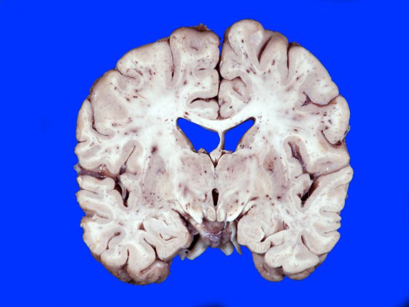 1A3 Fat Embolism (Case 1) 3