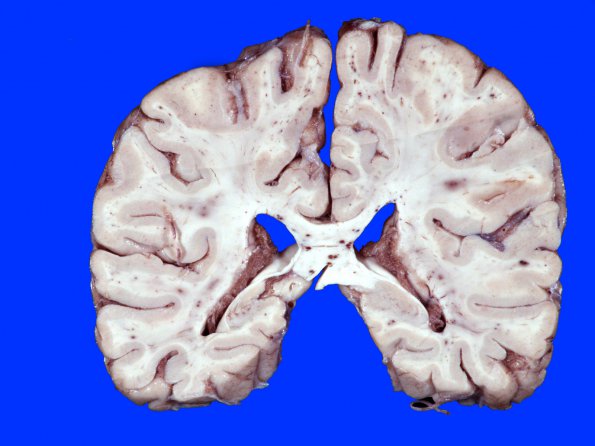 1A4 Fat Embolism (Case 1) 9