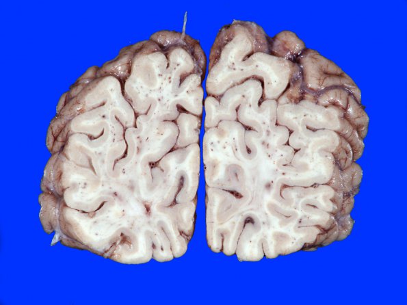 1A5 Fat Embolism (Case 1) 12