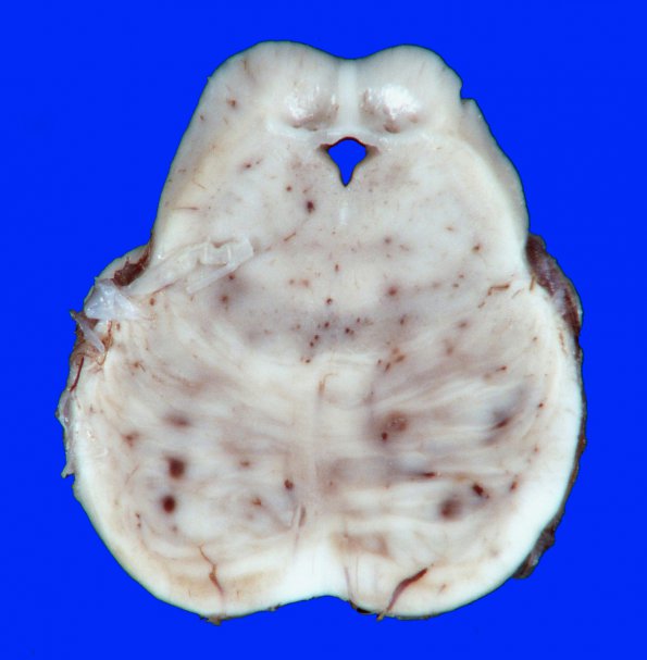 1A6 Embolism, fat (Case 1) gross_15