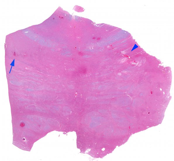 1B1 Fat Embolism (Case 1) Pons H&E 1