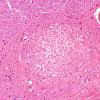 1B2 Fat Embolism (Case 1) H&E 1