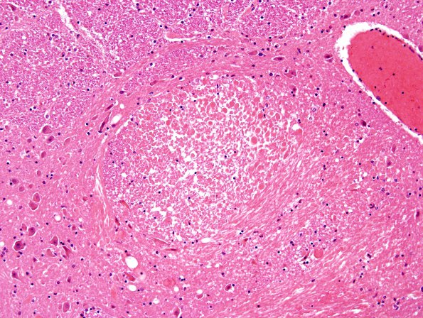 1B2 Fat Embolism (Case 1) H&E 1