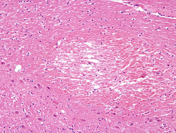 1B3 Fat Embolism (Case 1) H&E 10