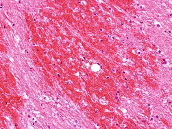 1B5 Fat Embolism (Case 1) H&E 3