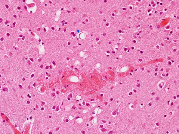 1B6 Fat Embolism (Case 1) H&E 4 copy