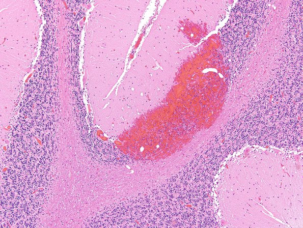 1B7 Fat Embolism (Case 1) H&E 6