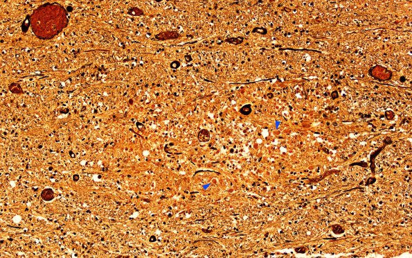 1C Fat Embolism (Case 1) N3 Biels N3 1 copy