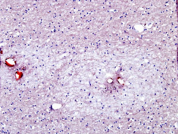 1D3 Fat Embolism (Case 1) ORO 3