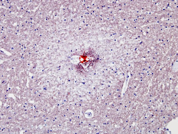 1D4 Fat Embolism (Case 1) ORO 9