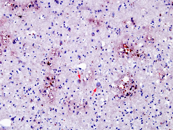 1D5 Embolism, fat (Case 1) ORO 12 copy