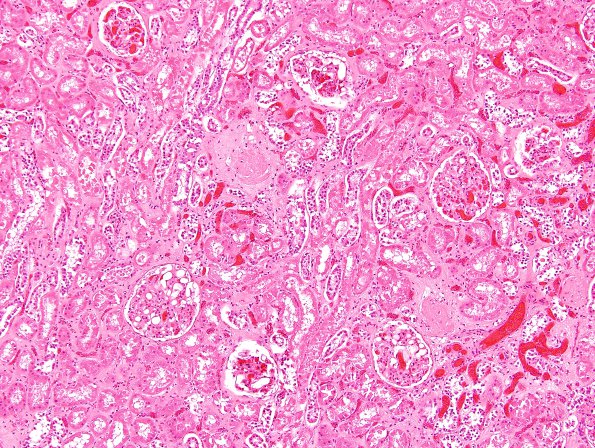 1E1 Fat Embolism (Case 1) Kidney H&E 4