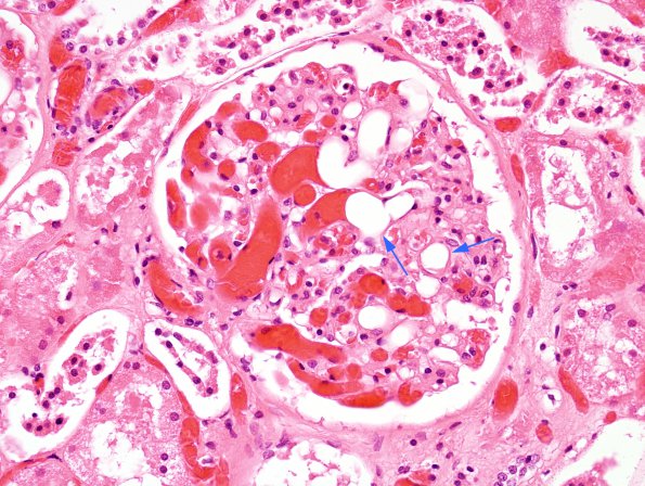 1E2 Fat Embolism (Case 1) Kidney H&E 2 copy