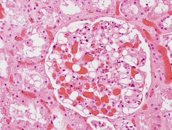 1E3 Fat Embolism (Case 1) Kidney H&E 5