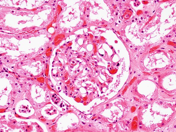 1E4 Fat Embolism (Case 1) Kidney H&E 3