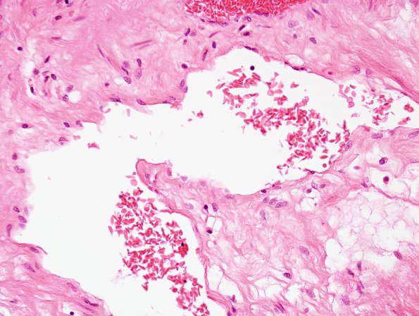 1E5 Fat Embolism (Case 1) Kidney H&E (sickled cells)