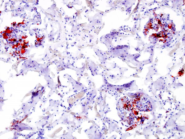 1F1 Fat Embolism (Case 1) Kidney ORO 3