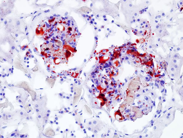 1F2 Fat Embolism (Case 1) Kidney ORO 2