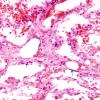 1G1 Fat Embolism (Case 1) Lung H&E 5 copy