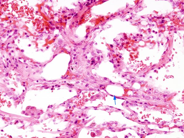 1G1 Fat Embolism (Case 1) Lung H&E 5 copy