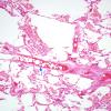 1G2 Fat Embolism (Case 1) Lung H&E 8 copy