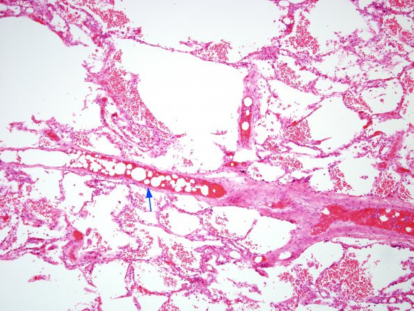 1G2 Fat Embolism (Case 1) Lung H&E 8 copy