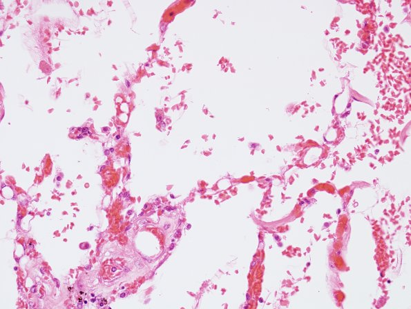 1G3 Fat Embolism (Case 1) Lung H&E 4