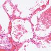 1G4 Fat Embolism (Case 1) Lung H&E 1