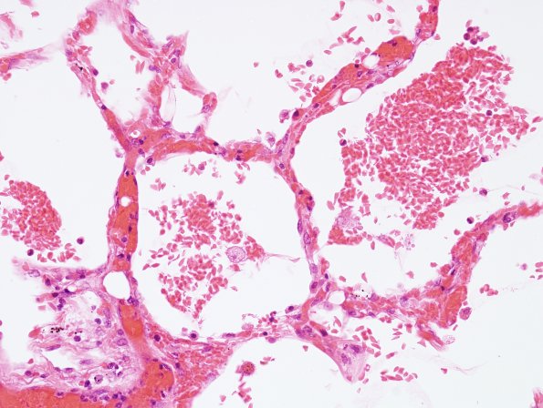 1G4 Fat Embolism (Case 1) Lung H&E 1