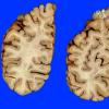 2A2 Fat Embolism (Case 2) Gross images _6