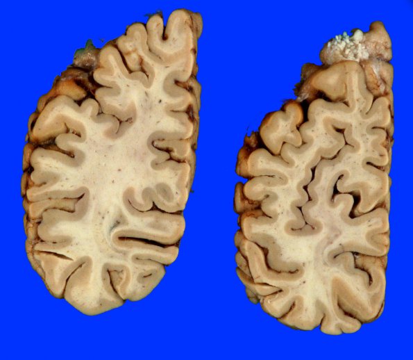 2A2 Fat Embolism (Case 2) Gross images _6