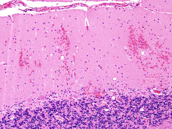 2B10 Fat Embolism (Case 2) H&E 28